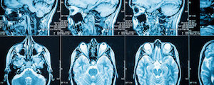 Brain Showing Symptoms of Concussion